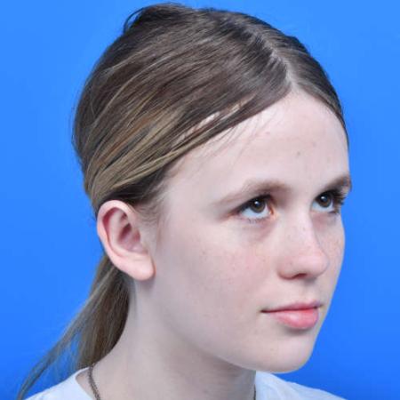 After image 2 Case #126226 - Otoplasty 14 year old
