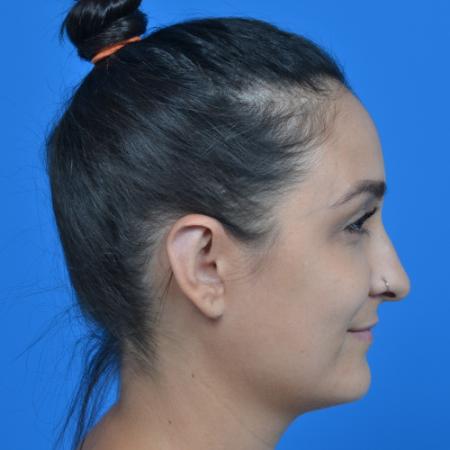After image 3 Case #126236 - otoplasty 27 year old woman