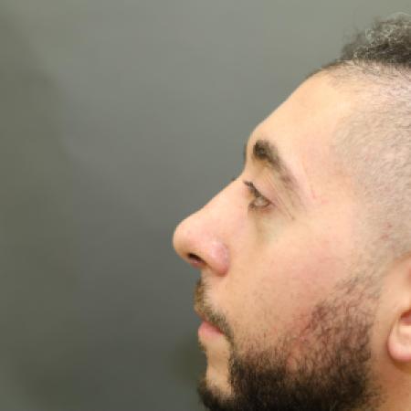 After image 2 Case #126831 - Rhinoplasty