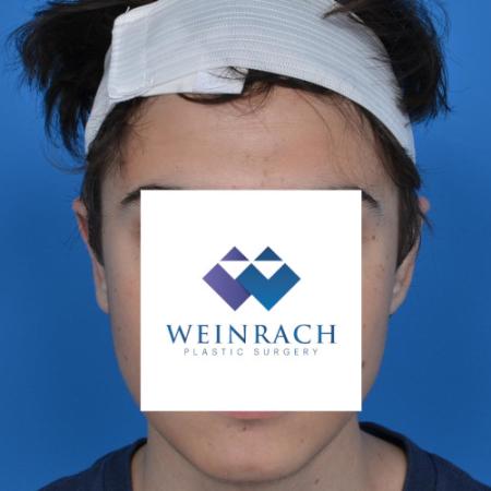 After image 1 Case #126231 - Otoplasty 18 year old