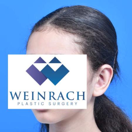 After image 2 Case #126221 - Otoplasty 11 year old