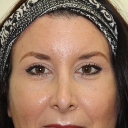 After image 1 Case #126861 - Blepharoplasty and Brow lift. 