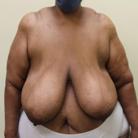 Before image 1 Case #126866 - Breast reduction with free nipple graft