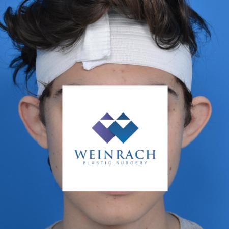 Before image 1 Case #126231 - Otoplasty 18 year old