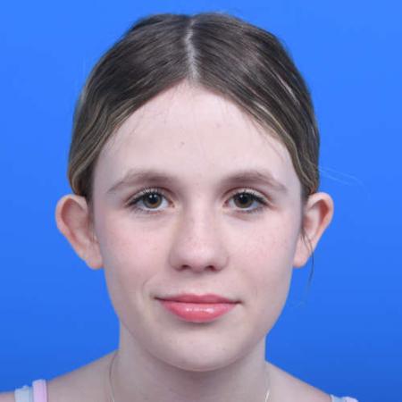 Before image 1 Case #126226 - Otoplasty 14 year old