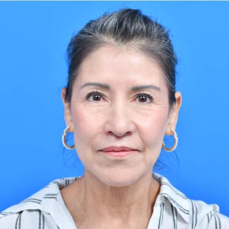 After image 1 Case #126556 - Lip Lift