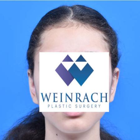 After image 1 Case #126221 - Otoplasty 11 year old