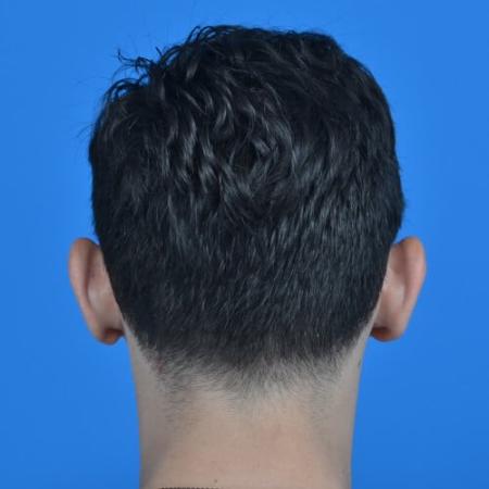 Before image 4 Case #126571 - Otoplasty 32 year old