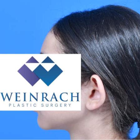 Before image 3 Case #126221 - Otoplasty 11 year old