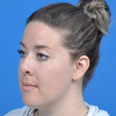 Before image 2 Case #126576 - otoplasty 31 year old woman