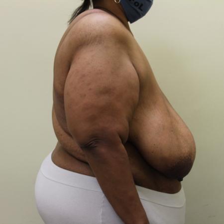 Before image 2 Case #126866 - Breast reduction with free nipple graft