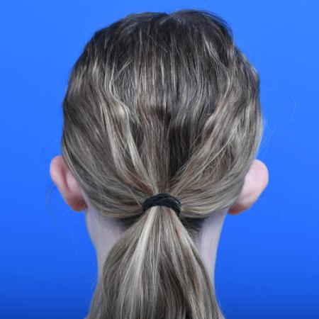 Before image 4 Case #126226 - Otoplasty 14 year old