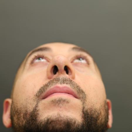 After image 3 Case #126831 - Rhinoplasty