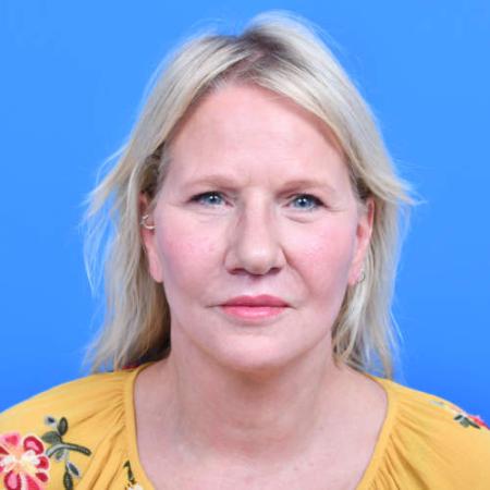 After image 1 Case #126561 - Lip lift