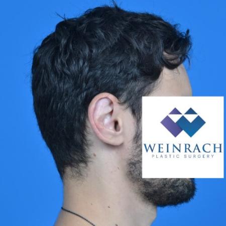 After image 3 Case #126571 - Otoplasty 32 year old