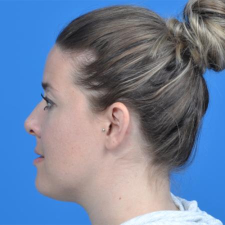 Before image 3 Case #126576 - otoplasty 31 year old woman