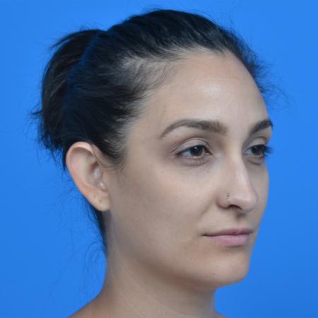 Before image 2 Case #126236 - otoplasty 27 year old woman