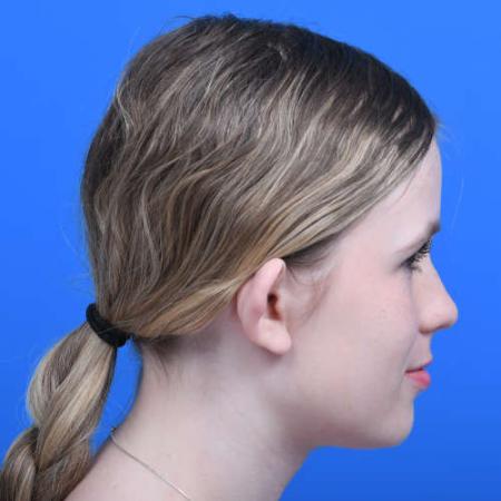 Before image 3 Case #126226 - Otoplasty 14 year old