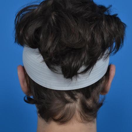 After image 4 Case #126231 - Otoplasty 18 year old