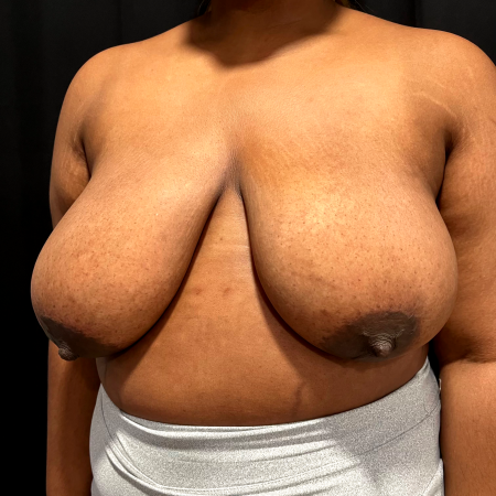 Before image 2 Case #127516 - Breast Reduction