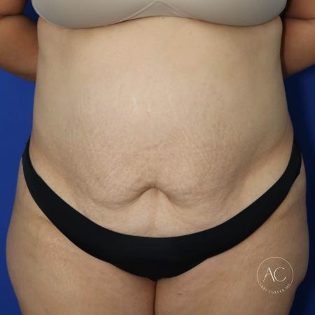 Before image 1 Case #127456 - Circumferential trunk lipo and abdominoplasty