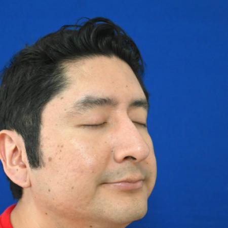 Before image 2 Case #127141 - Case 6 - Rhinoplasty