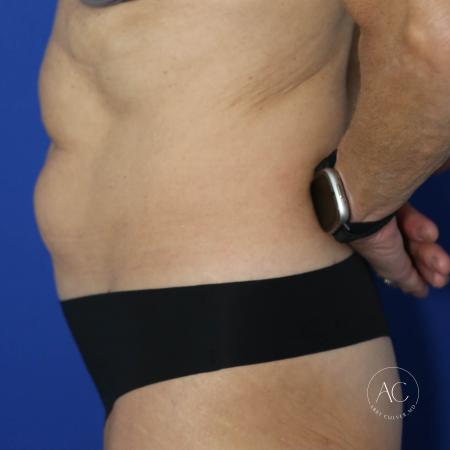 Before image 3 Case #127496 - Abdominoplasty