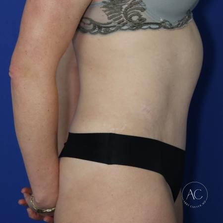 After image 3 Case #127486 - Liposuction and abdominoplasty