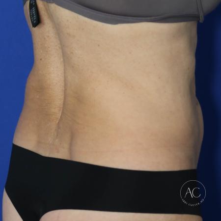 Before image 4 Case #127496 - Abdominoplasty