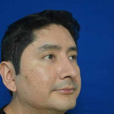 After image 2 Case #127141 - Case 6 - Rhinoplasty