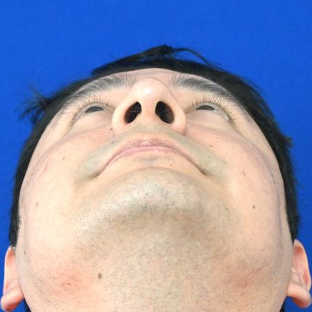 Before image 4 Case #127141 - Case 6 - Rhinoplasty