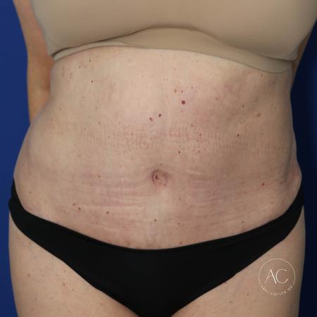 After image 1 Case #127481 - Circumferential trunk lipo and abdominoplasty