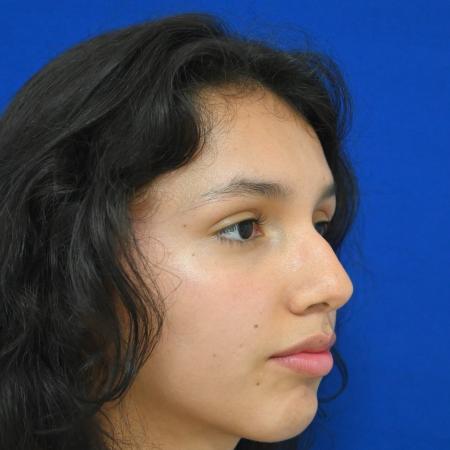 Before image 2 Case #127121 - Case 1 - Rhinoplasty 