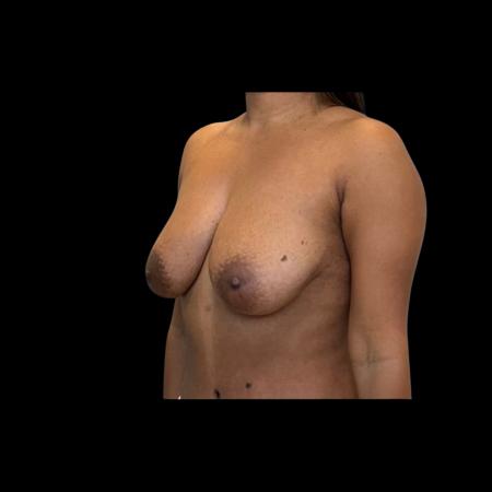 Before image 4 Case #126936 - Mastopexy Without Implants 