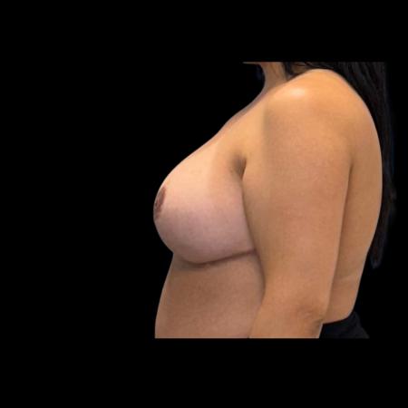 After image 5 Case #126941 - Breast Reduction