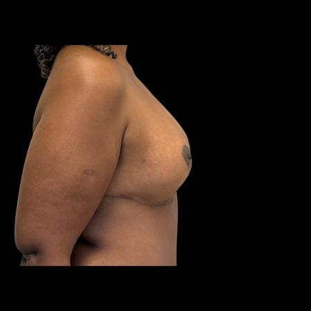 After image 3 Case #126946 - Mastopexy without Implants 
