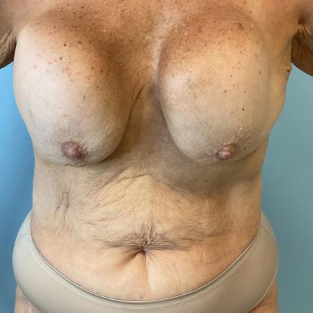 Before image 1 Case #127161 - 60 year old Breast Implant revision w/ tummy tuck