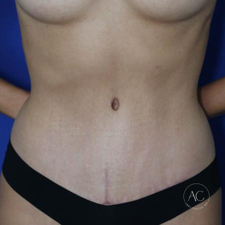 After image 1 Case #127436 - Abdominoplasty