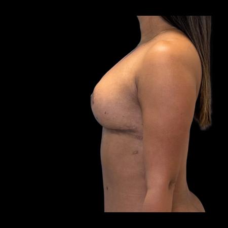 After image 5 Case #126936 - Mastopexy Without Implants 