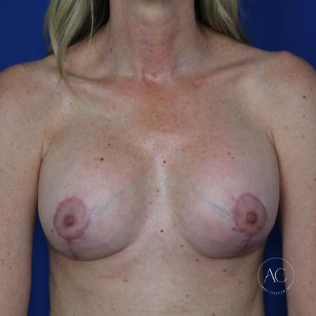After image 1 Case #127511 - Breast implant exchange with lift