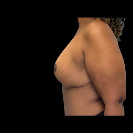 After image 5 Case #126946 - Mastopexy without Implants 