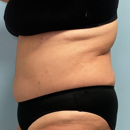 After image 3 Case #127386 - 35 y.o. female w/ Tummy Tuck & Lipo of flanks 