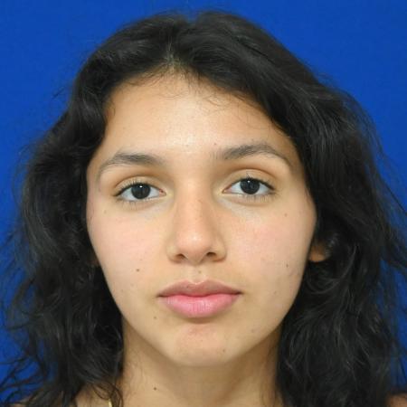 Before image 1 Case #127121 - Case 1 - Rhinoplasty 