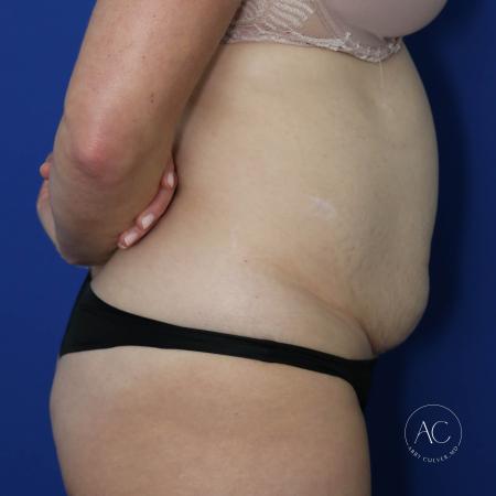 Before image 3 Case #127486 - Liposuction and abdominoplasty