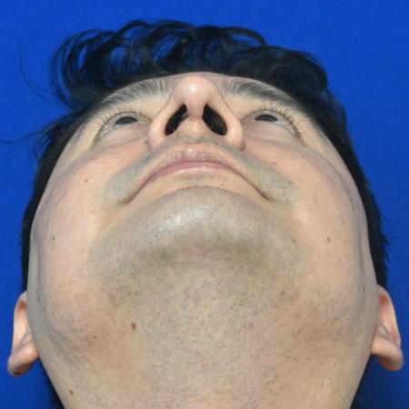 After image 4 Case #127141 - Case 6 - Rhinoplasty