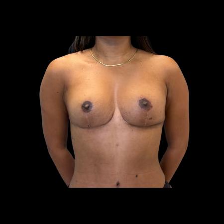 After image 6 Case #126936 - Mastopexy Without Implants 