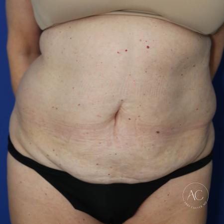 Before image 1 Case #127481 - Circumferential trunk lipo and abdominoplasty