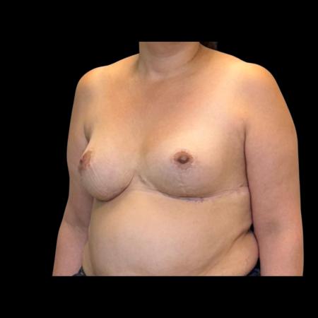 After image 6 Case #126951 - Revision mastopexy