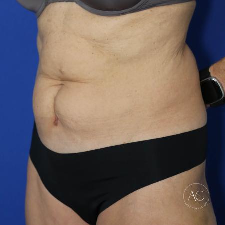 Before image 2 Case #127496 - Abdominoplasty