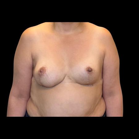 After image 1 Case #126951 - Revision mastopexy